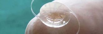 Lente intraocular miopía